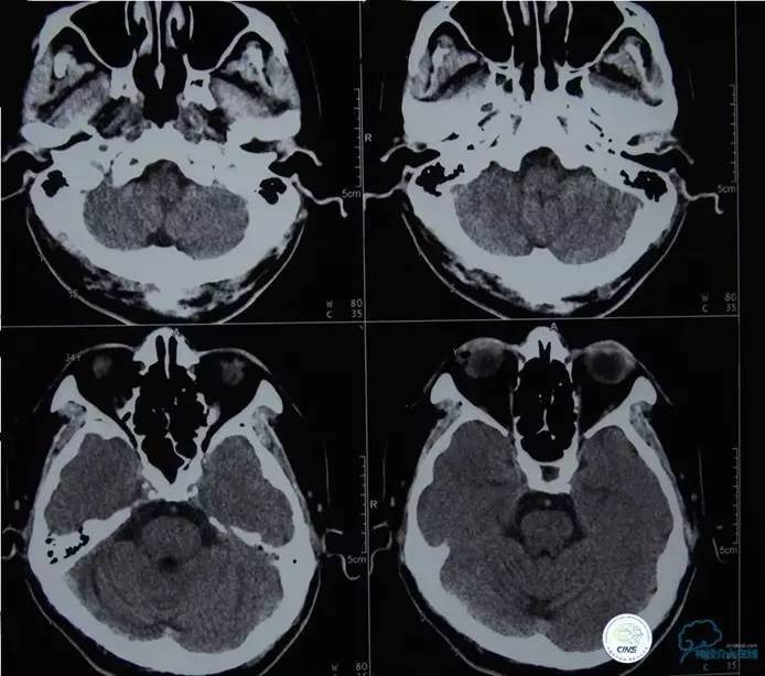 急性缺血性卒中静脉溶栓2018指南,急性缺血性卒中血管内再通标准
