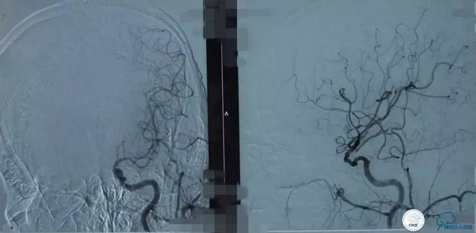 急性缺血性卒中静脉溶栓2018指南,急性缺血性卒中血管内再通标准