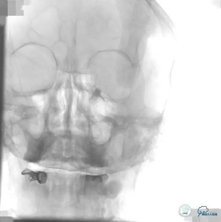 急性缺血性卒中静脉溶栓2018指南,急性缺血性卒中血管内再通标准