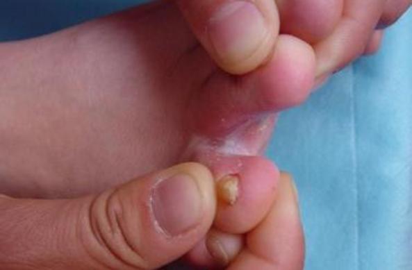 大道至简殊不知简单才是最难的,什么植物能治愈脚后跟裂开