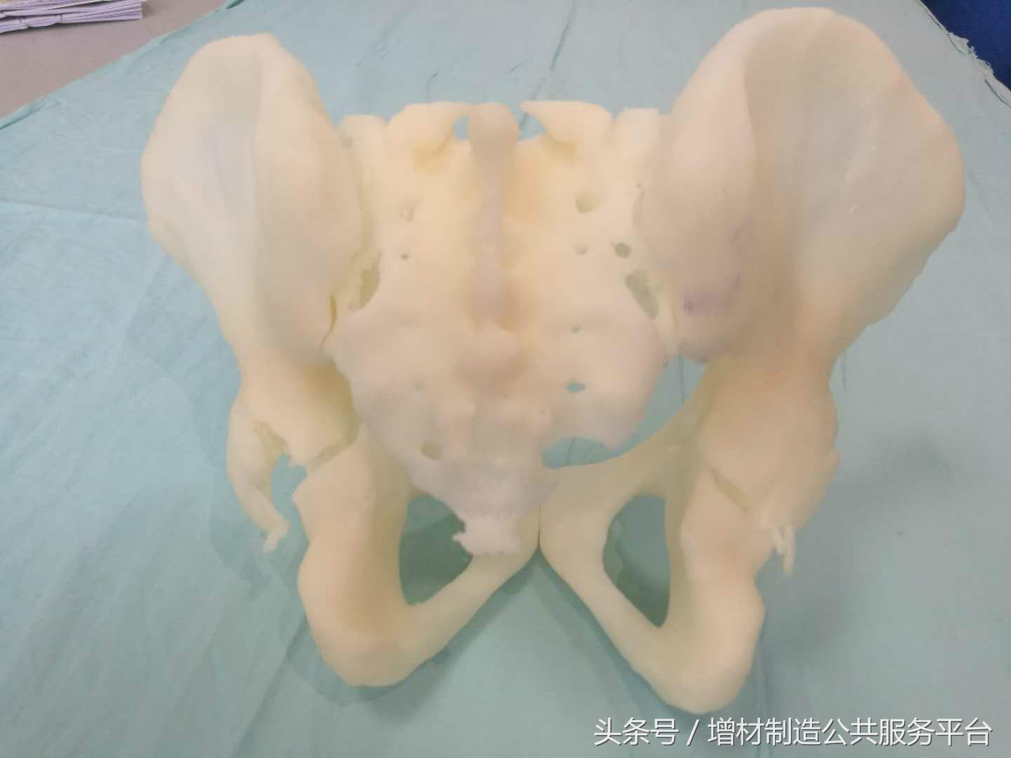 3d打印骨盆骨折成功案例,骨盆骨折抢救视频