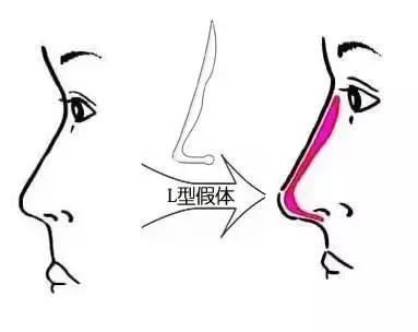 假体隆鼻都有什么术式,假体隆鼻一般用什么材料