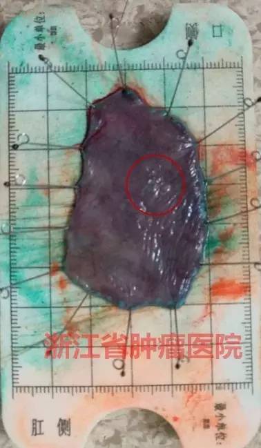 食管黏膜病变越大就一定是恶性吗,食管病变严重需要怎么治疗