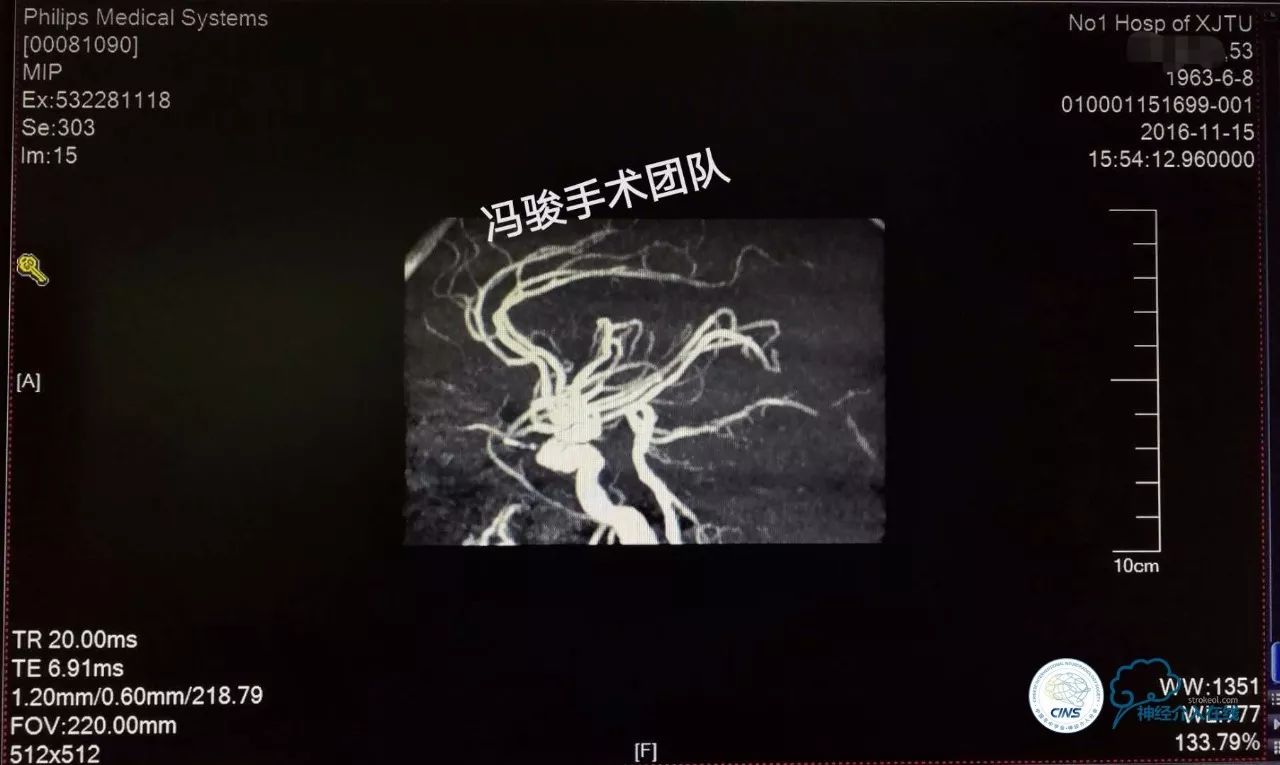 天新福—百家百言｜一例孤独椎动脉V4段并PICA重度狭窄支架手术及1年随访