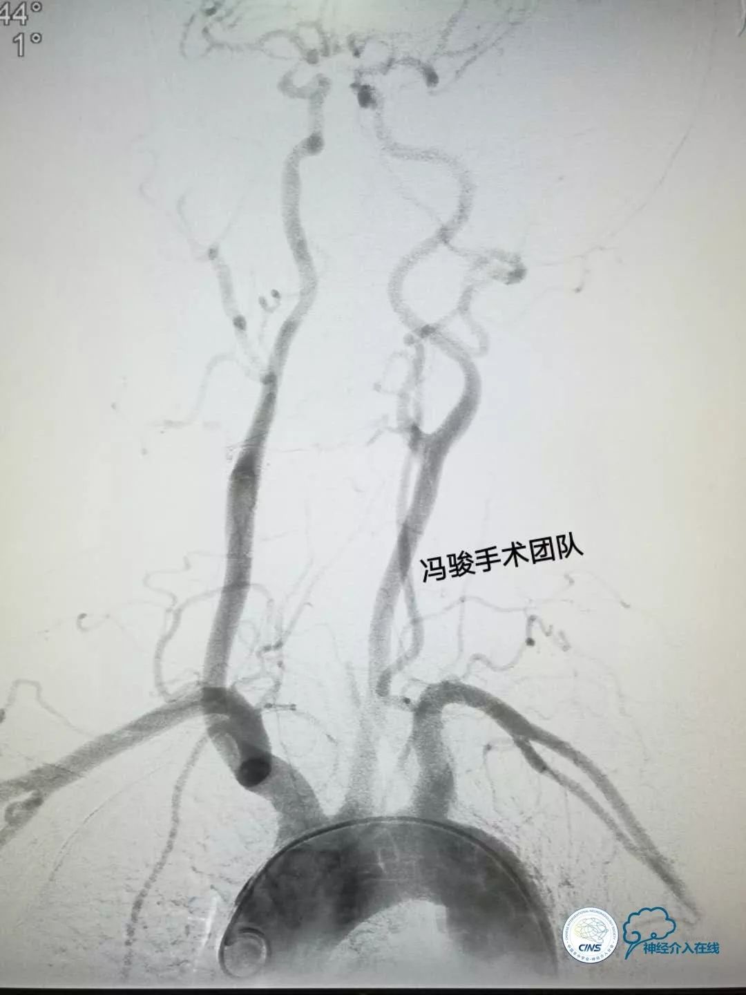 天新福—百家百言｜一例孤独椎动脉V4段并PICA重度狭窄支架手术及1年随访