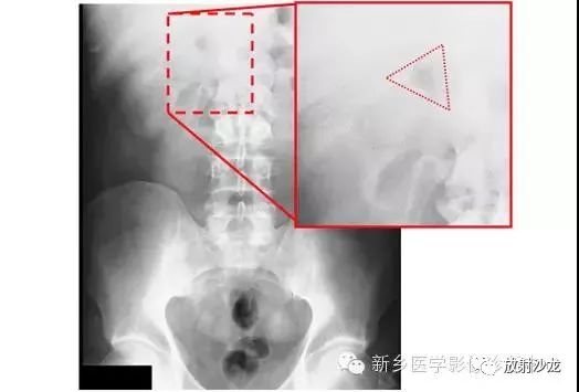详细腹部平片解剖+正常表现+读片技巧+病例分析