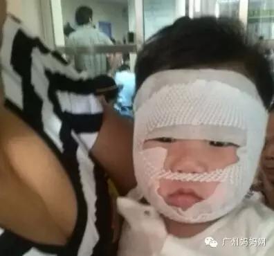 湿疹挠破皮肤感染,过敏性湿疹挠破化脓了