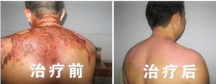 伤口怎样不留疤痕最好的方法,皮肤伤口怎么不留疤痕