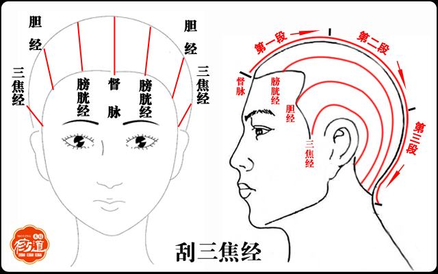 偏头痛刮痧眼睛有点肿了,眼睛干涩刮痧刮哪里