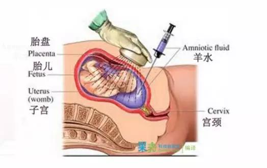 羊膜穿刺肚子特别疼怎么办,打了羊膜穿刺肚子微痛