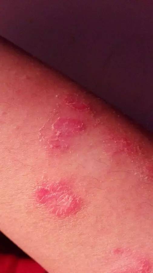 与牛皮癣抗争的十年艰辛路,牛皮癣银屑病患者福音