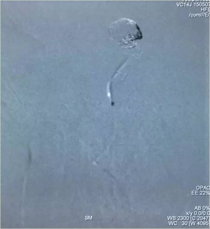 基底动脉顶端动脉瘤加左侧小脑上动脉瘤以Y型支架结合弹簧圈栓塞