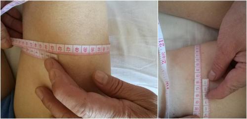 老年腿肿血栓用做手术吗,老人腿部血栓不治的后果