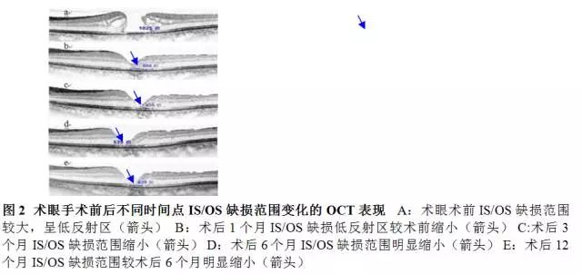 玻璃体移植,玻璃体切除联合手术