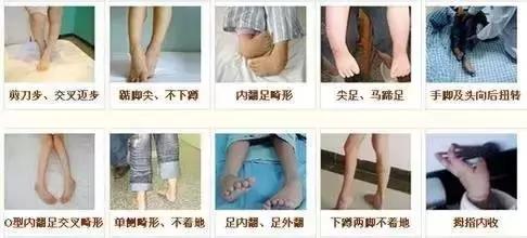 小孩剪刀腿,小孩剪刀腿是怎么回事