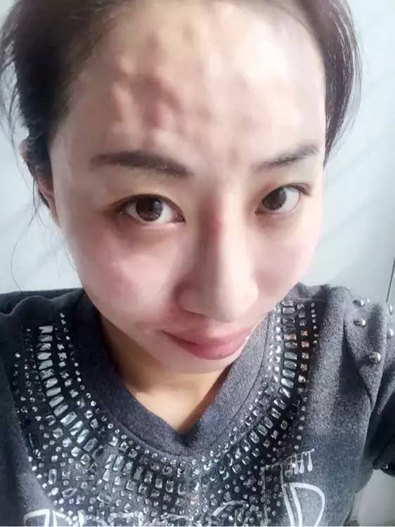 一次水光针=200片面膜？是真的！但为啥我还是不推荐你打水光针？