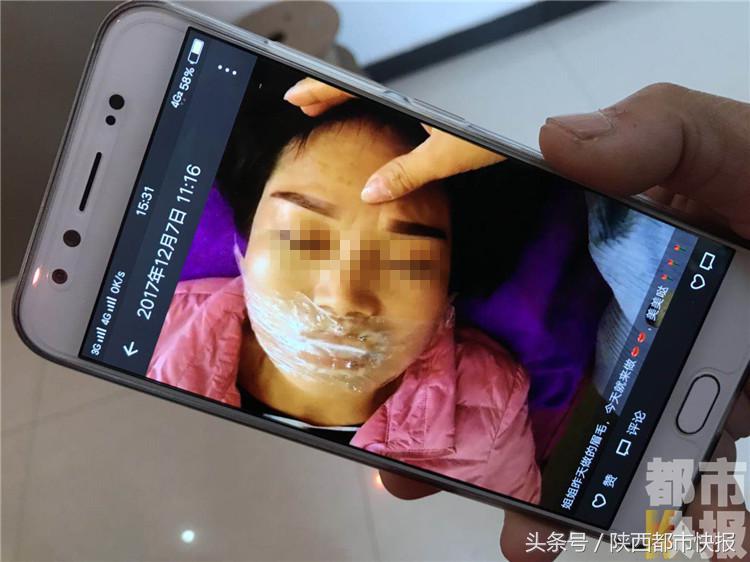 女子千元漂唇肿胀五天如“香肠”