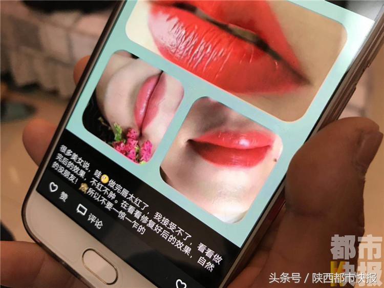 女子千元漂唇肿胀五天如“香肠”