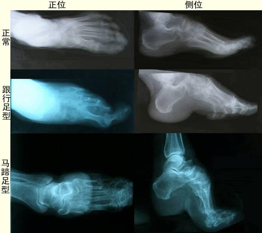 裹小脚的故事,最近的裹小脚事件