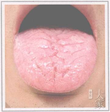 裂纹舌诊与疾病对照图,舌有裂纹六种舌象告诉你