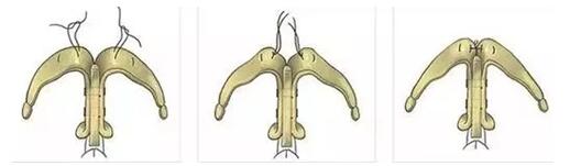 鼻综合隆鼻用什么材料,耳软骨和肋骨隆鼻费用多少钱