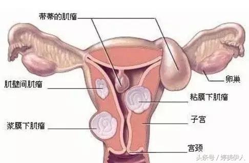 女性怎么预防子宫疾病,女人要预防的妇科疾病