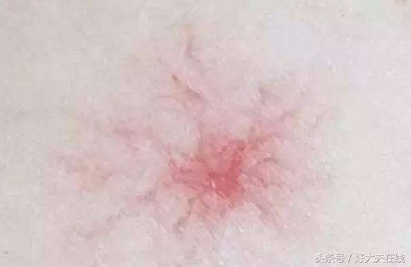 黑色胎记手术切除后还会癌变吗,孩子脸上有棕褐色胎记会癌变吗