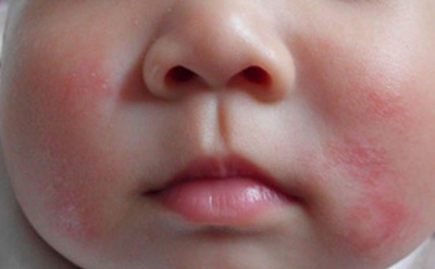 引起宝宝湿疹的原因和解决方案,宝宝容易长湿疹妈妈应该注意什么