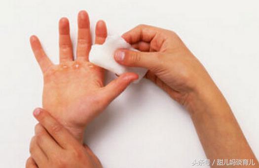 1岁婴儿被开水烫伤掉皮会留疤吗,宝宝烫伤怎么不留疤痕小妙招