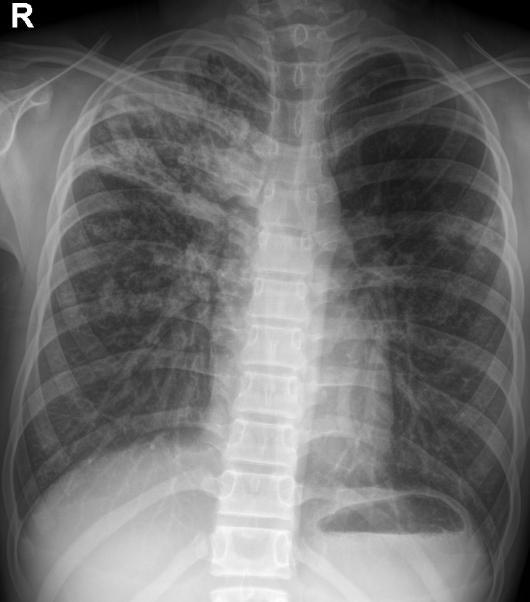 为什么臀部会发育不良,小孩臀部肌肉松弛