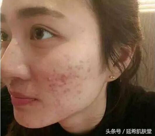 换季就长痘什么原因,一到换季就长痘怎么回事