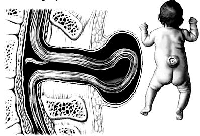 小儿隐性脊柱裂手术多少钱,新生儿隐性脊柱裂手术多大做合适