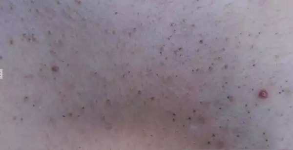 酒渣鼻怎么改善学生党,酒渣鼻严重怎么彻底治疗