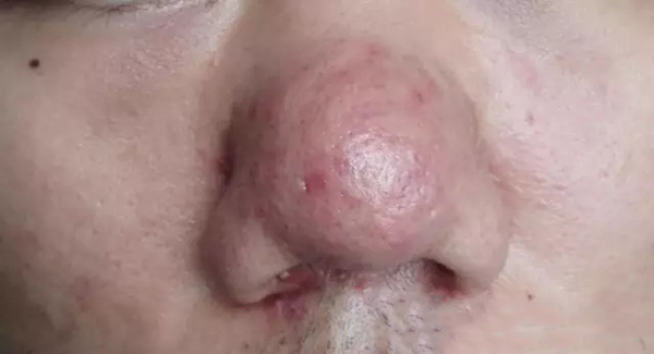 酒渣鼻严重怎么彻底治疗,酒渣鼻难道真的看不好吗
