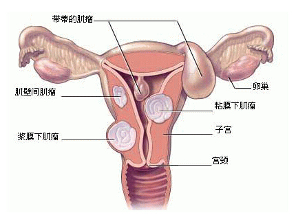 从病因、症状到治疗方法,你想知道的子宫肌瘤知识都在这里啦!
