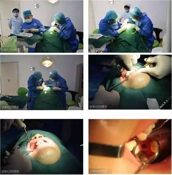 骨粉植牙失败,植牙失败后第二次种会成功吗