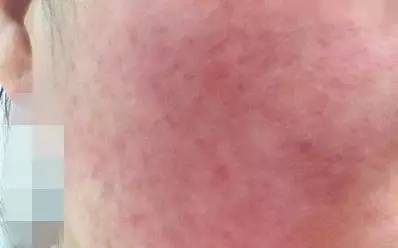 女生脸上过敏红肿痒起小疙瘩,脸上出现红肿是什么原因