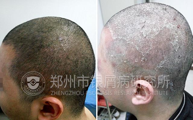 银屑病绝不能忌口,银屑病真的不能用激素么