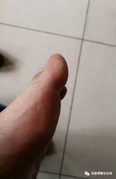 小腿前面的肌肉僵硬,小腿前方肌肉僵硬