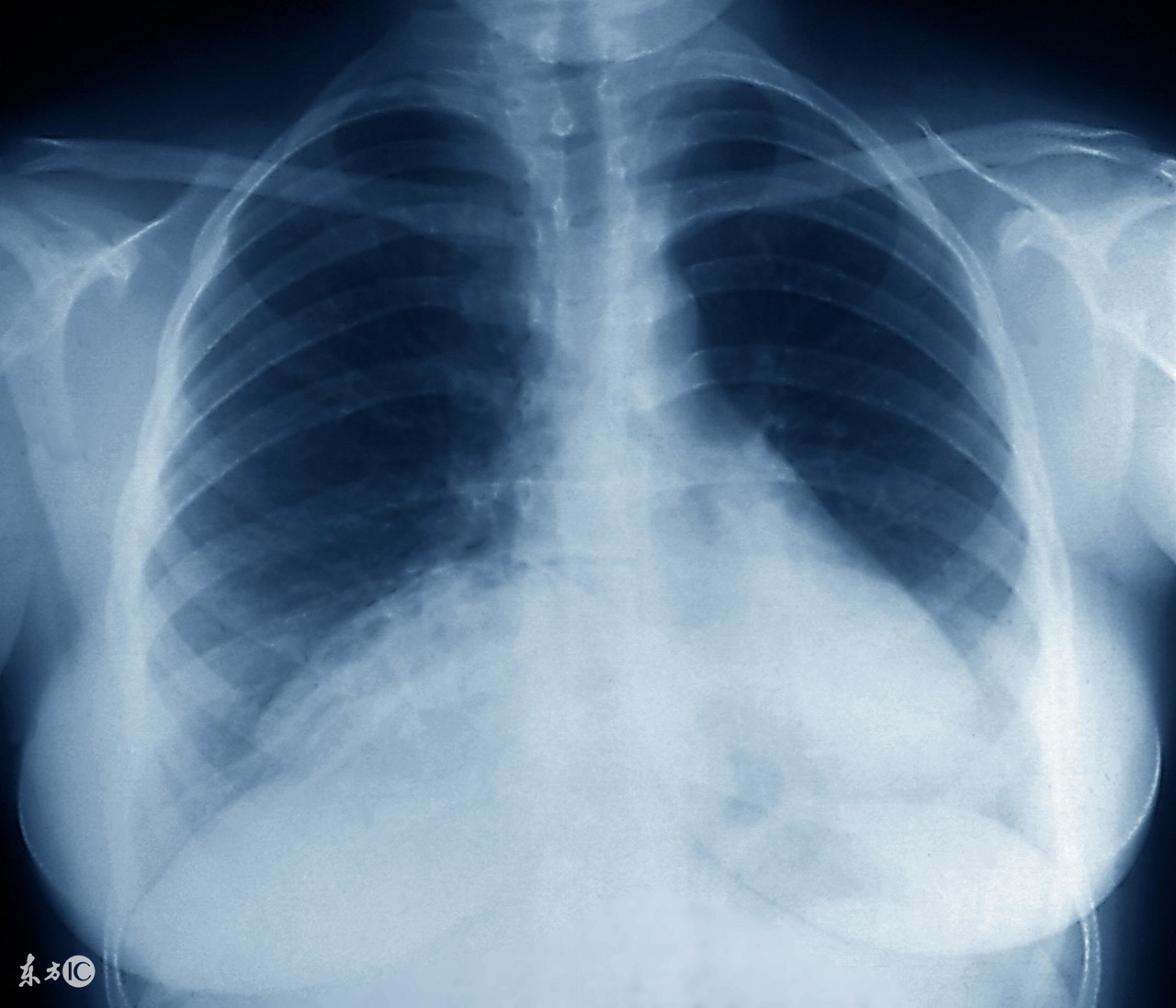 支原体肺炎总反复能彻底治愈吗,两岁宝宝肺炎支原体感染反复咳嗽