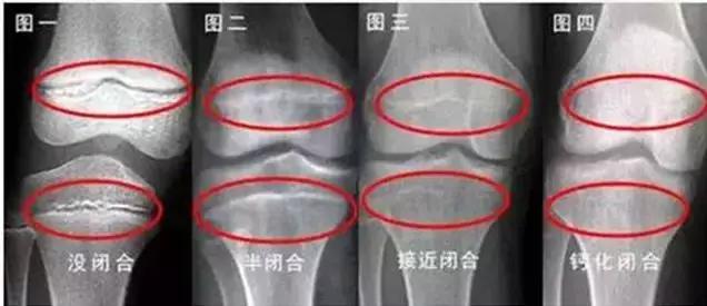 青枝骨折愈合大致分为三期,儿童青枝骨折的特点以及处理要点