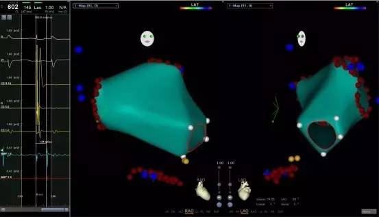 马长生房颤的最好治疗方法,马长生房颤消融后复发