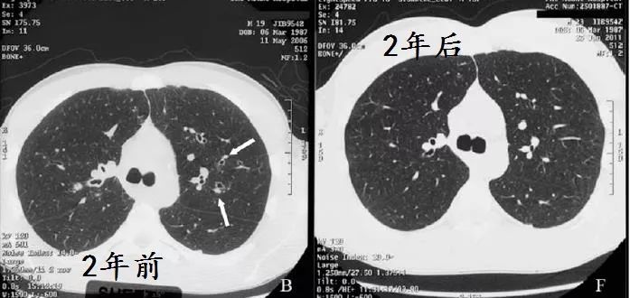 支气管扩张能治好吗要怎么治,支气管扩张能治好吗如何治疗