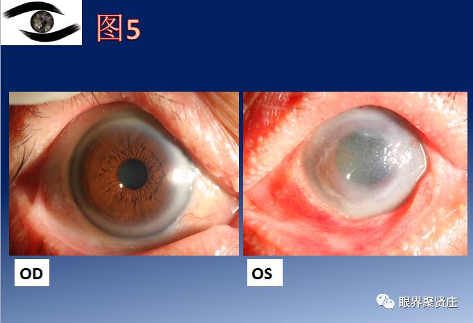 几种眼病的视野图,看图识病是什么病