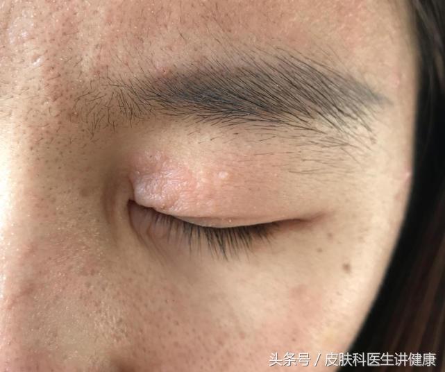 神经性皮炎初期可见瘙痒和皮疹,慢性皮疹和神经性皮炎的鉴别