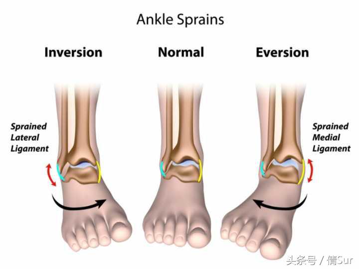 轻度脚踝扭伤几个疗程,脚踝反复扭伤的旧伤怎么治疗
