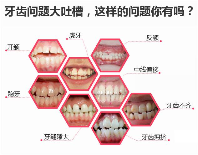 隐形矫正免费试戴,《芳华》女主也来打Call
