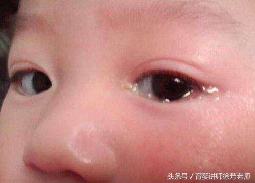 宝宝有眼屎吃什么调理,眼睛有眼屎是什么症状