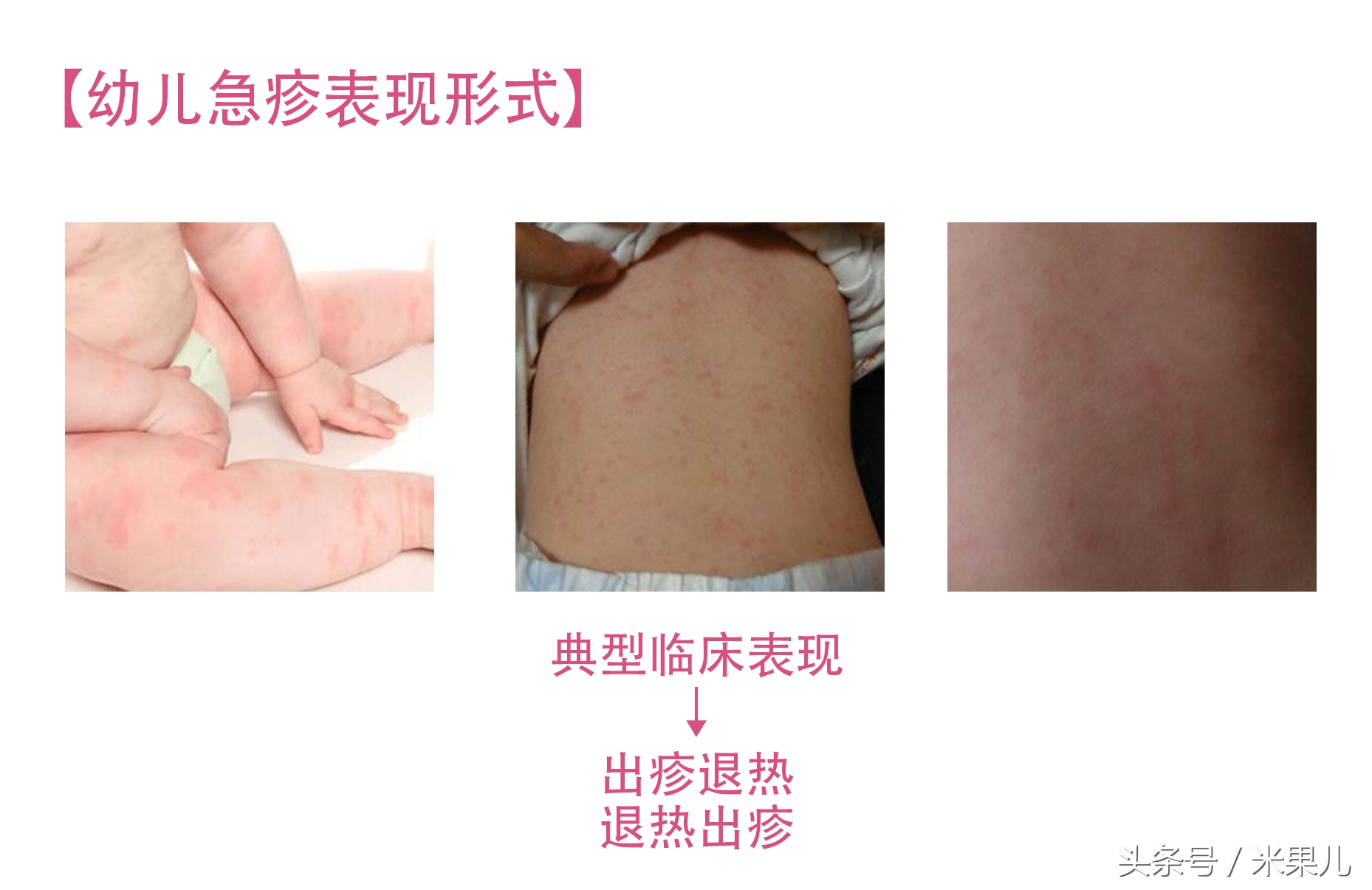 宝宝过敏怎么办新手爸妈秘籍,妈妈过敏体质宝宝怎么办