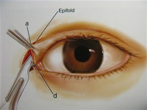 做过埋线还能做双眼皮切开手术吗,陈小剑做双眼皮案例